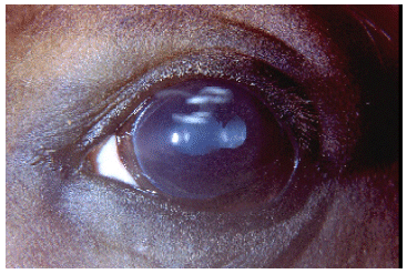 Uveitis ocasionada por Leptospirosis equina