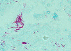 Mycobacterium bovis 